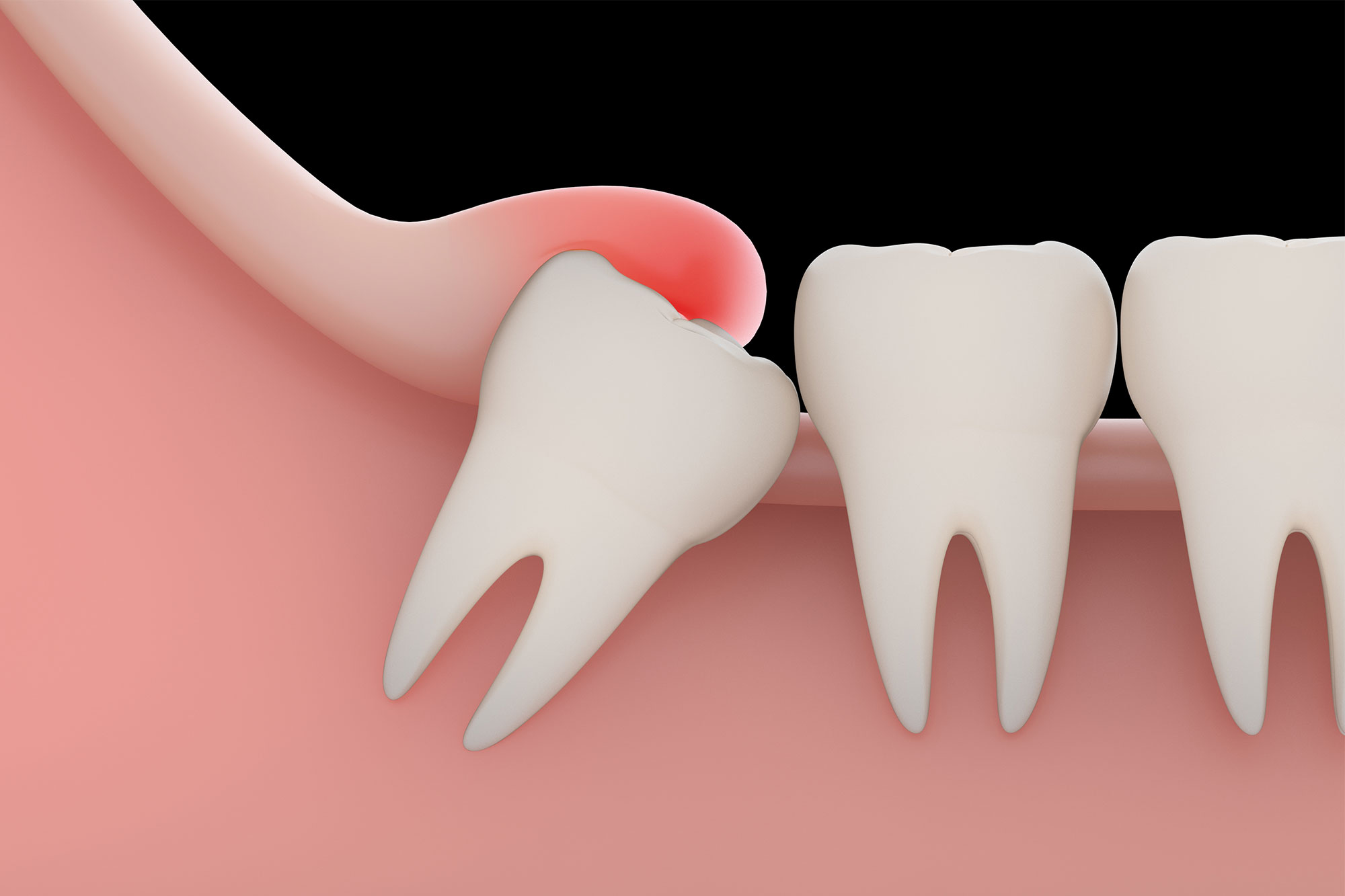 Cpt Code For Impacted Wisdom Teeth Removal