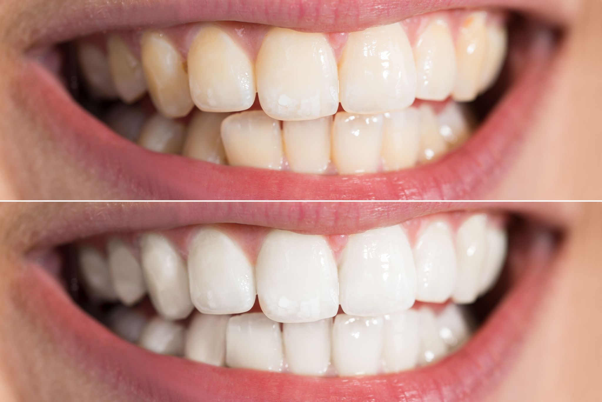 How to Whiten Your Yellow Teeth